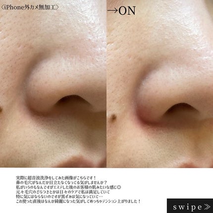 ウォーターピーリング/ANLAN/美顔器・マッサージを使ったクチコミ(6枚目)