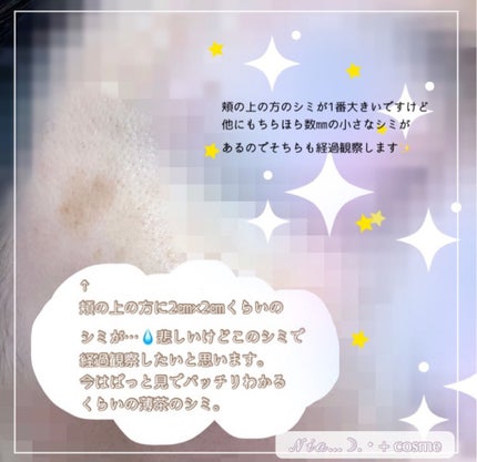 薬用しみ集中対策 プレミアム美容液/メラノCC/美容液を使ったクチコミ(5枚目)