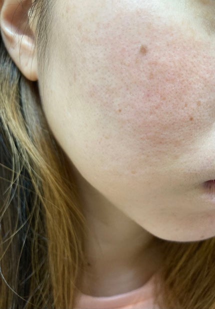 しい on LIPS 「カソーダ22日目順調に皮むけ中!特に鼻がポロポロ!〜カソーダを..」(4枚目)