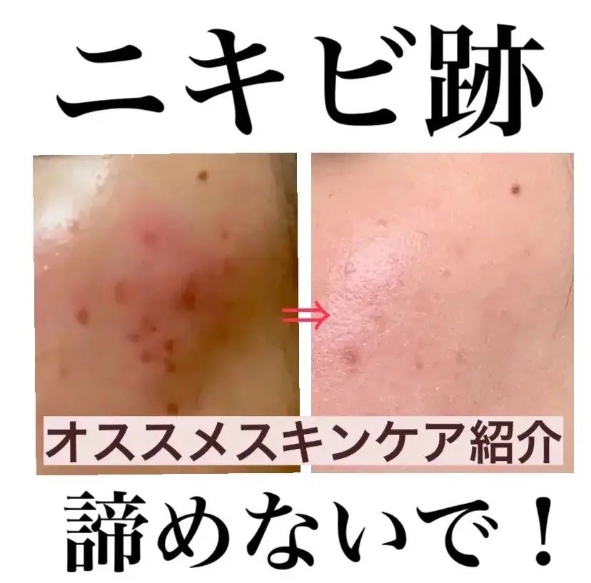 クリアフル ローションL(さっぱりタイプ)/オルビス/化粧水を使ったクチコミ(1枚目)