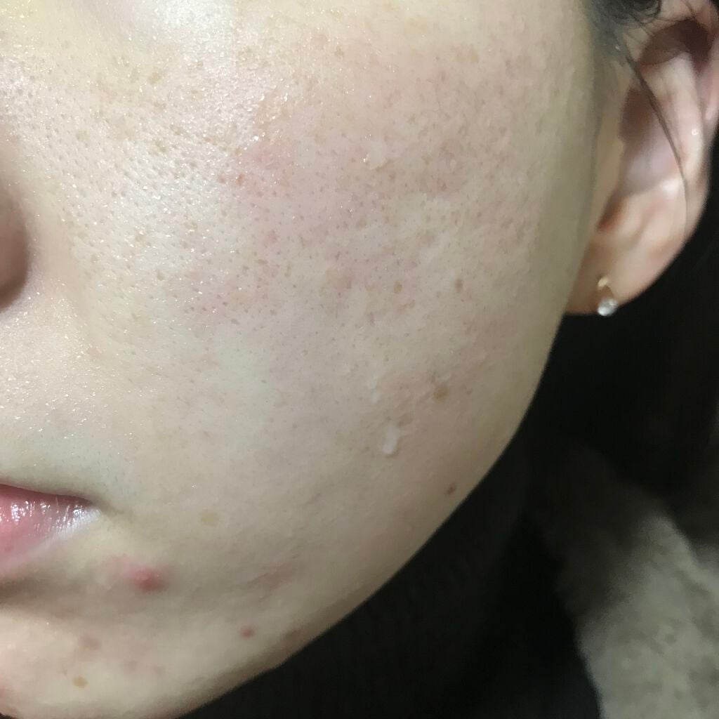 A-zero Shot Trouble Dressing Spot Patch/MEDIHEAL/シートマスク・パックを使ったクチコミ(2枚目)