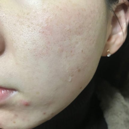 A-zero Shot Trouble Dressing Spot Patch/MEDIHEAL/シートマスク・パックを使ったクチコミ(2枚目)