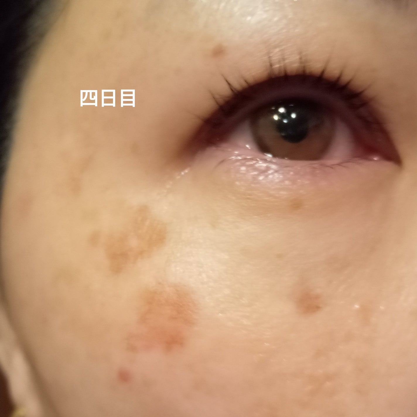 ビヨンセ奥二重向上委員長🥸LIPSパートナー🥳 on LIPS 「ついに!!この時が🤣🩷シミ取りレーザー全記録です🙌🙌🙌(五日目..」(7枚目)