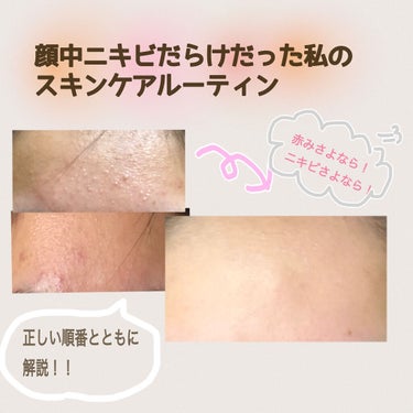 薬用ふわふわな泡洗顔/メンソレータム アクネス/泡洗顔を使ったクチコミ（1枚目）