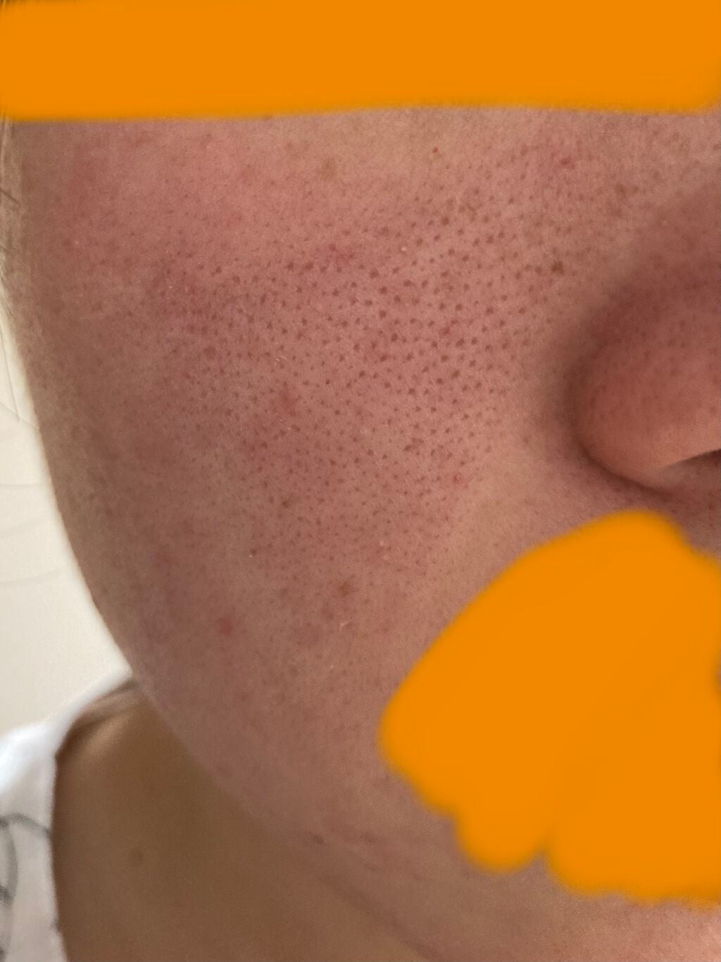 博多美人になりたい on LIPS 「助けてください!!頬あたりの毛穴のぽっかり??が酷いんです🥺治..」(2枚目)