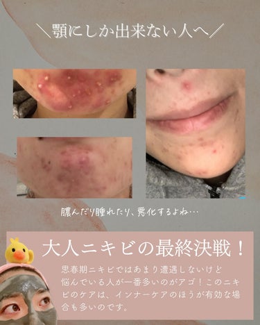 おゆみ|ニキビ・ニキビ跡ケア on LIPS 「@______ohyoume　他の投稿はこちらから👋✨こんばん..」（2枚目）