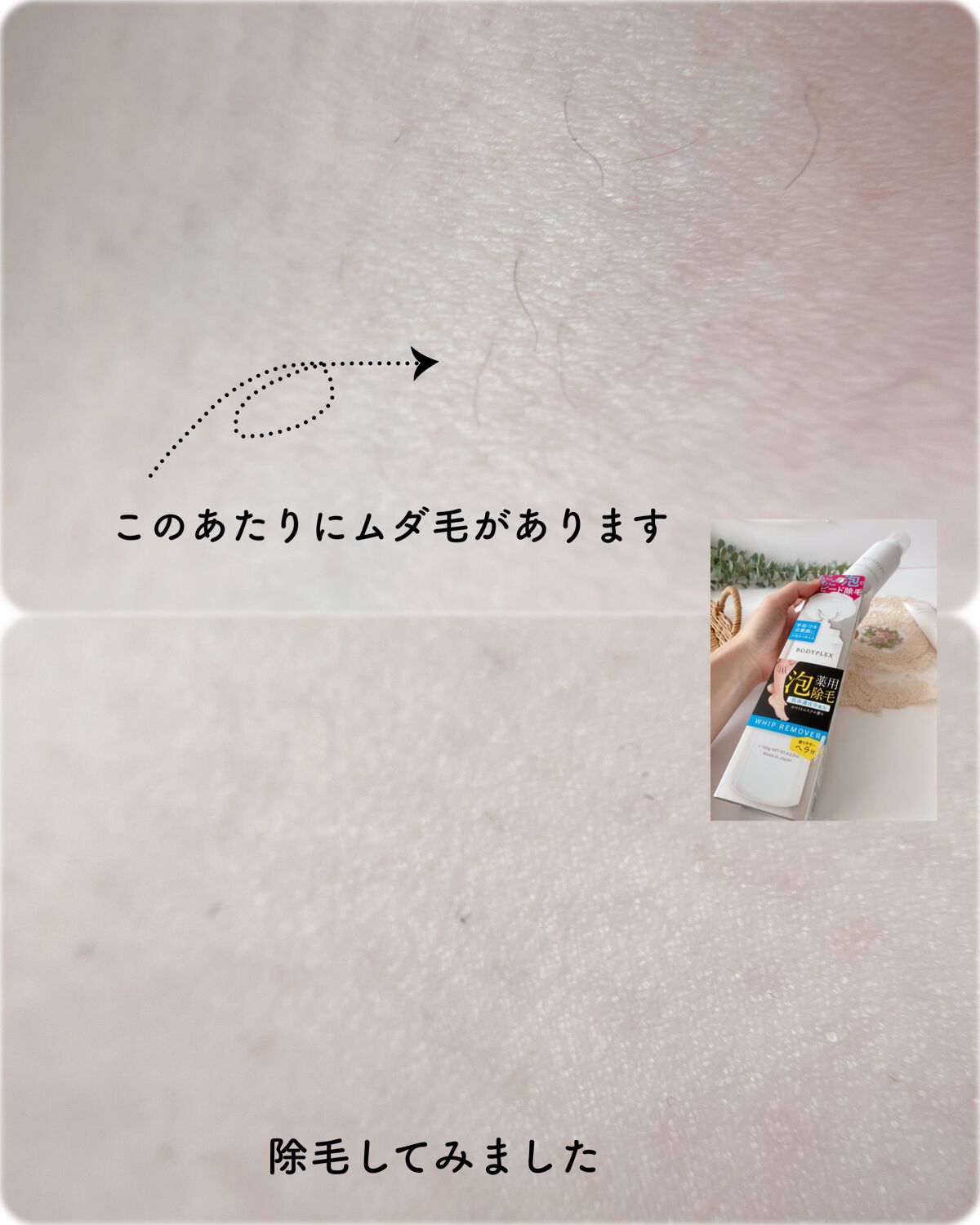 エミリー@フォロバ100 on LIPS 「・・ボディプレックスホイップリムーバーEX医薬部外品ボディプレ..」(6枚目)