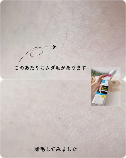 エミリー@フォロバ100 on LIPS 「・・ボディプレックスホイップリムーバーEX医薬部外品ボディプレ..」(6枚目)