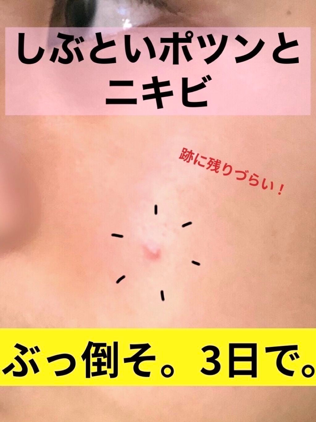 からしちゃん on LIPS 「どうもっからしです。今回は、厄介な赤ニキビ・黄ニキビをたった数..」(1枚目)