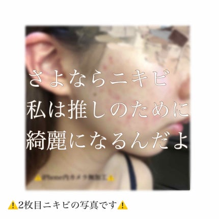 アクアチムローション、アクアチムクリーム(医薬品)/大塚製薬/その他を使ったクチコミ(1枚目)