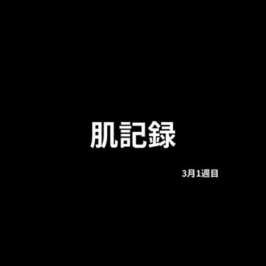 悲報　2022.3.5
〜しこりニキビ再発〜

抗生物質様のおかげででかいしこりは最近できてませんでした。が、
抗生物質は5日分だけだったのでもう飲み終えて二週間が経ちますので、しこりニキビも元気に再発