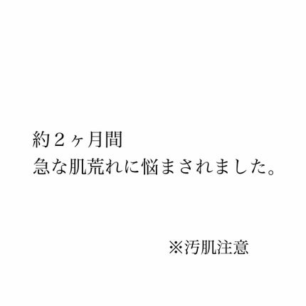 アクアチムローション、アクアチムクリーム(医薬品)/大塚製薬/その他を使ったクチコミ(1枚目)