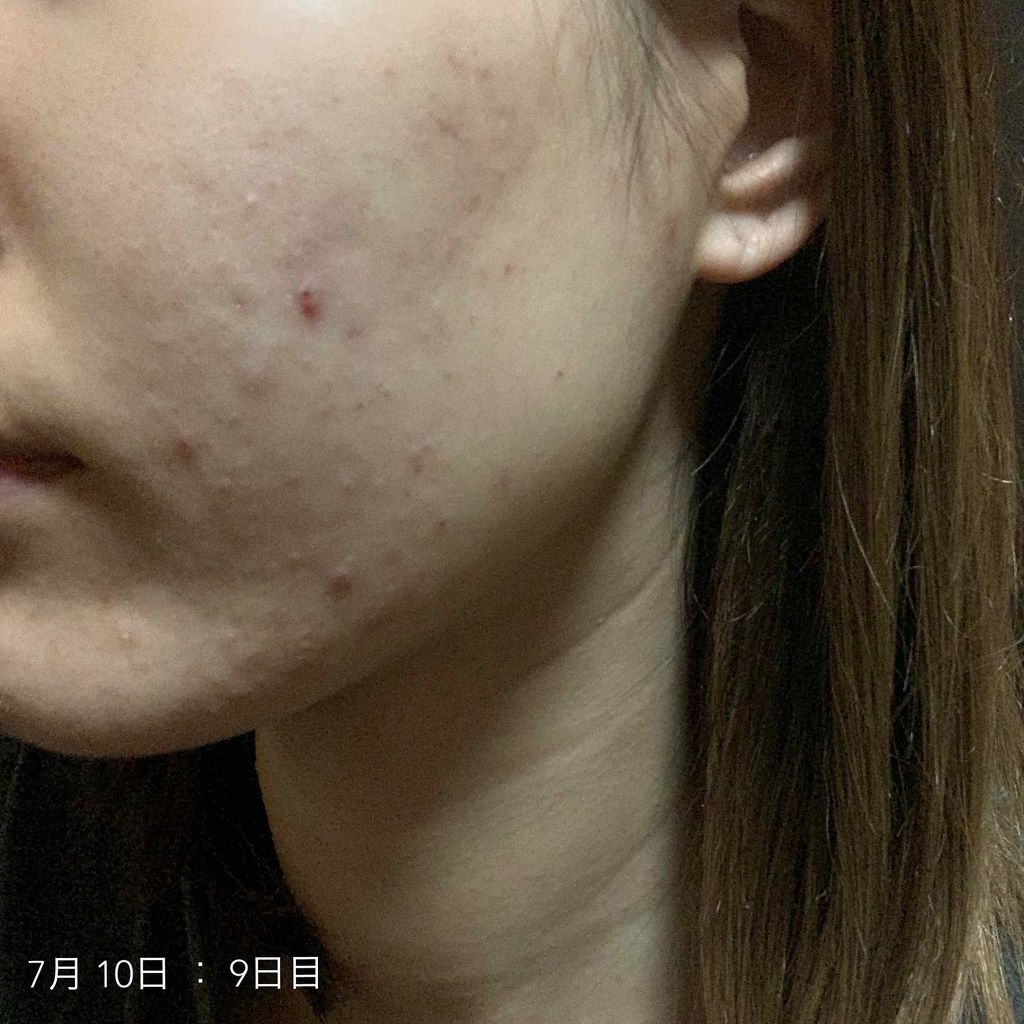 バランスケア ローション W II/d プログラム/化粧水を使ったクチコミ（2枚目）