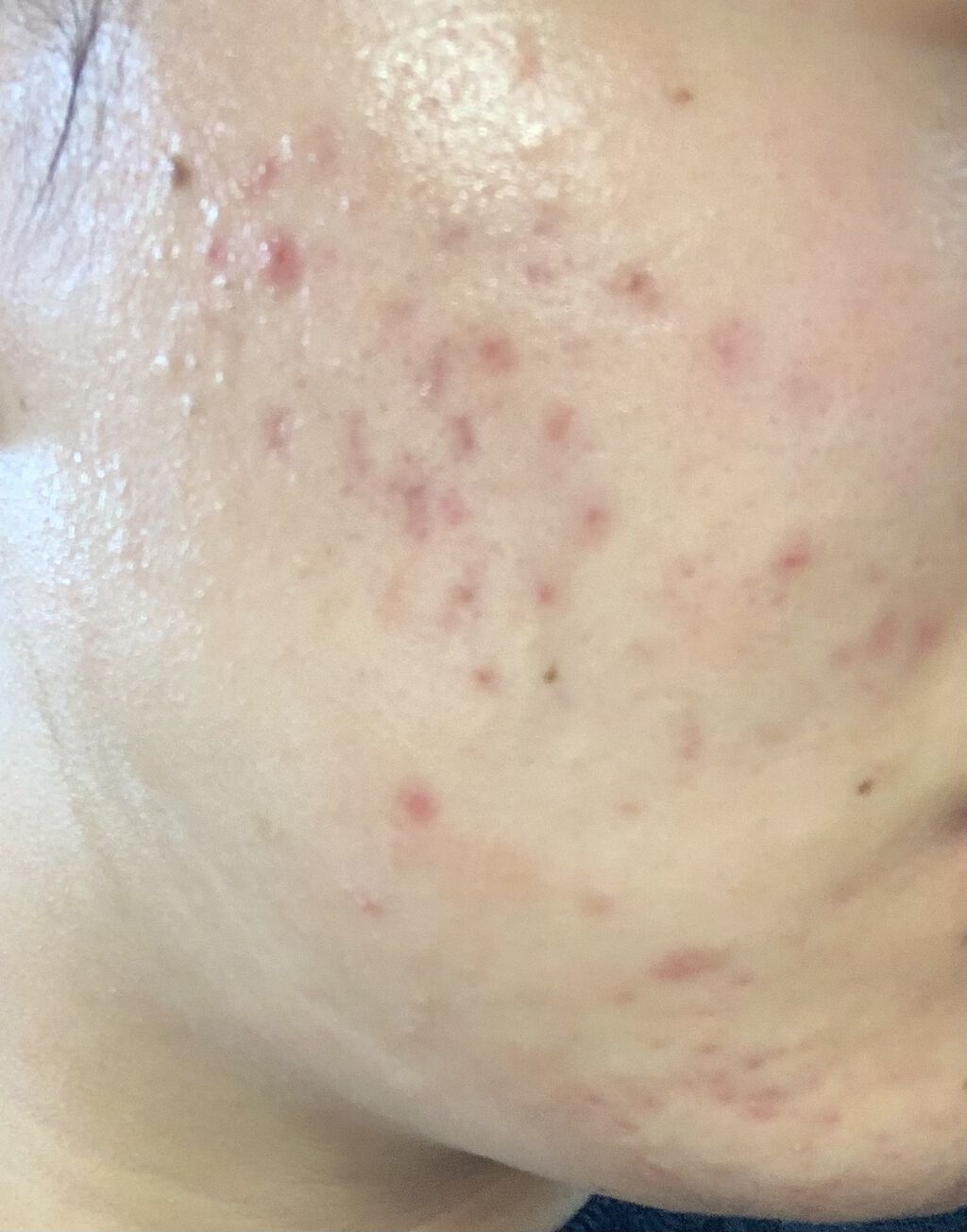 クリンダマイシンゲル(医薬品)/クラシエ薬品/その他を使ったクチコミ（2枚目）