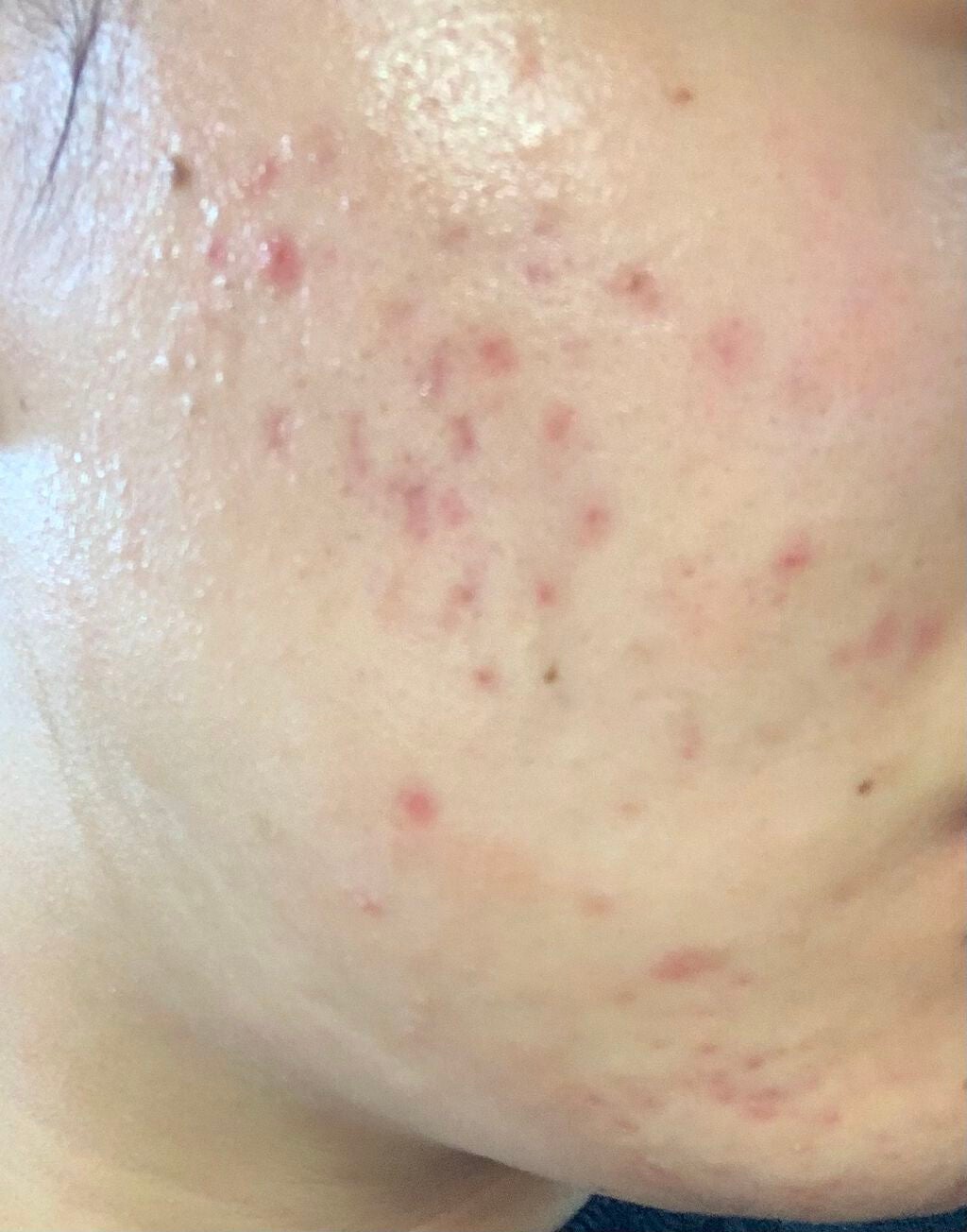 とろり on LIPS 「右頬ニキビ跡だけになっとる...なに急に?心変わりした???と..」(2枚目)