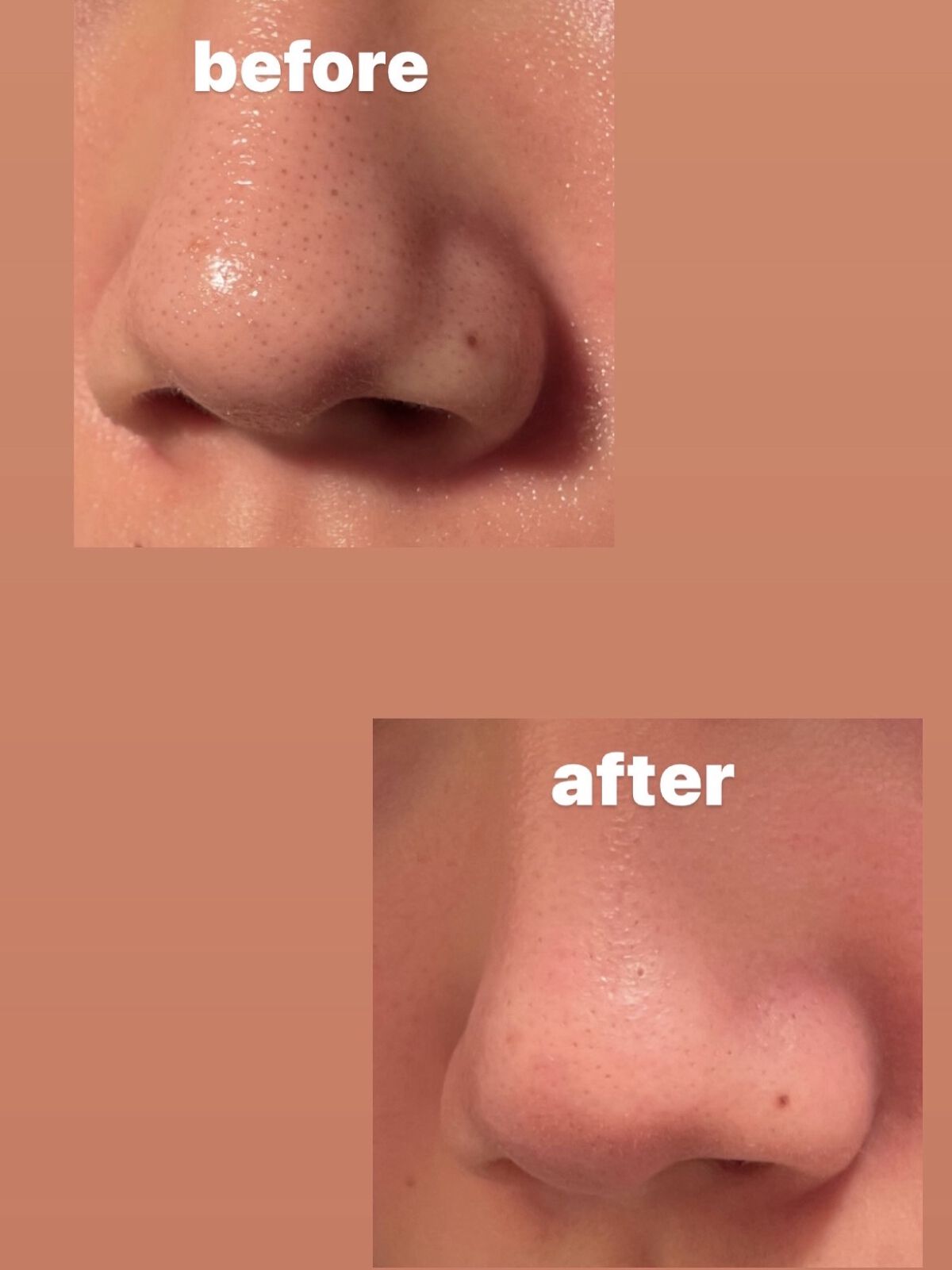 薬用しみ集中対策 プレミアム美容液/メラノCC/美容液を使ったクチコミ（1枚目）