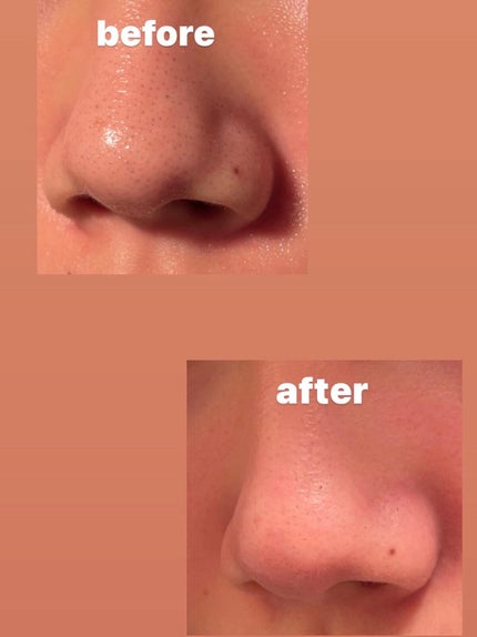 ダーマレーザー スーパーVC100ローション(さっぱり)/クオリティファースト/化粧水を使ったクチコミ(1枚目)