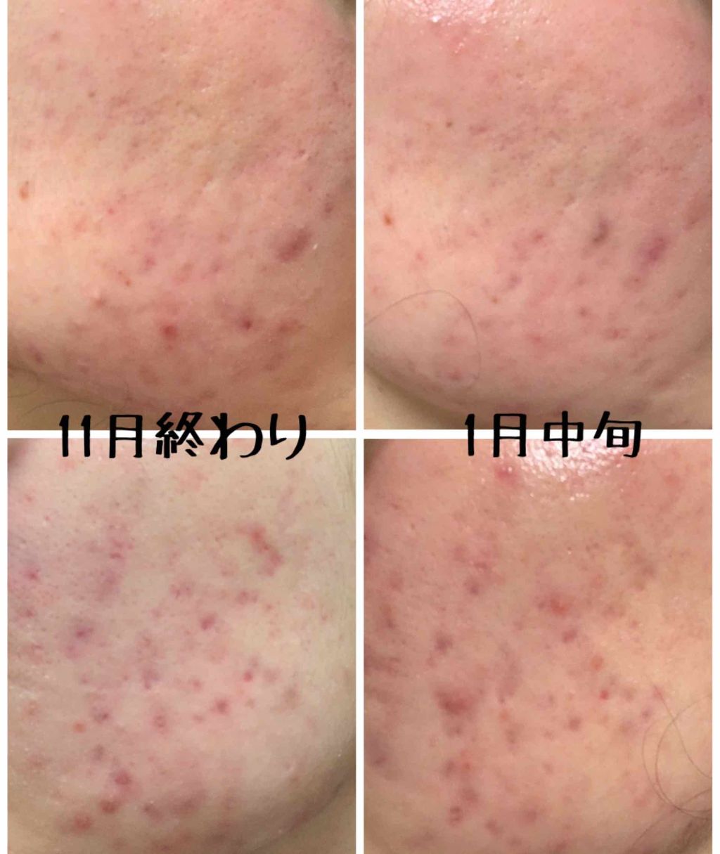 まな on LIPS 「どうも。⚠️2枚目に汚い肌の写真があります⚠️まあみていただけ..」(2枚目)