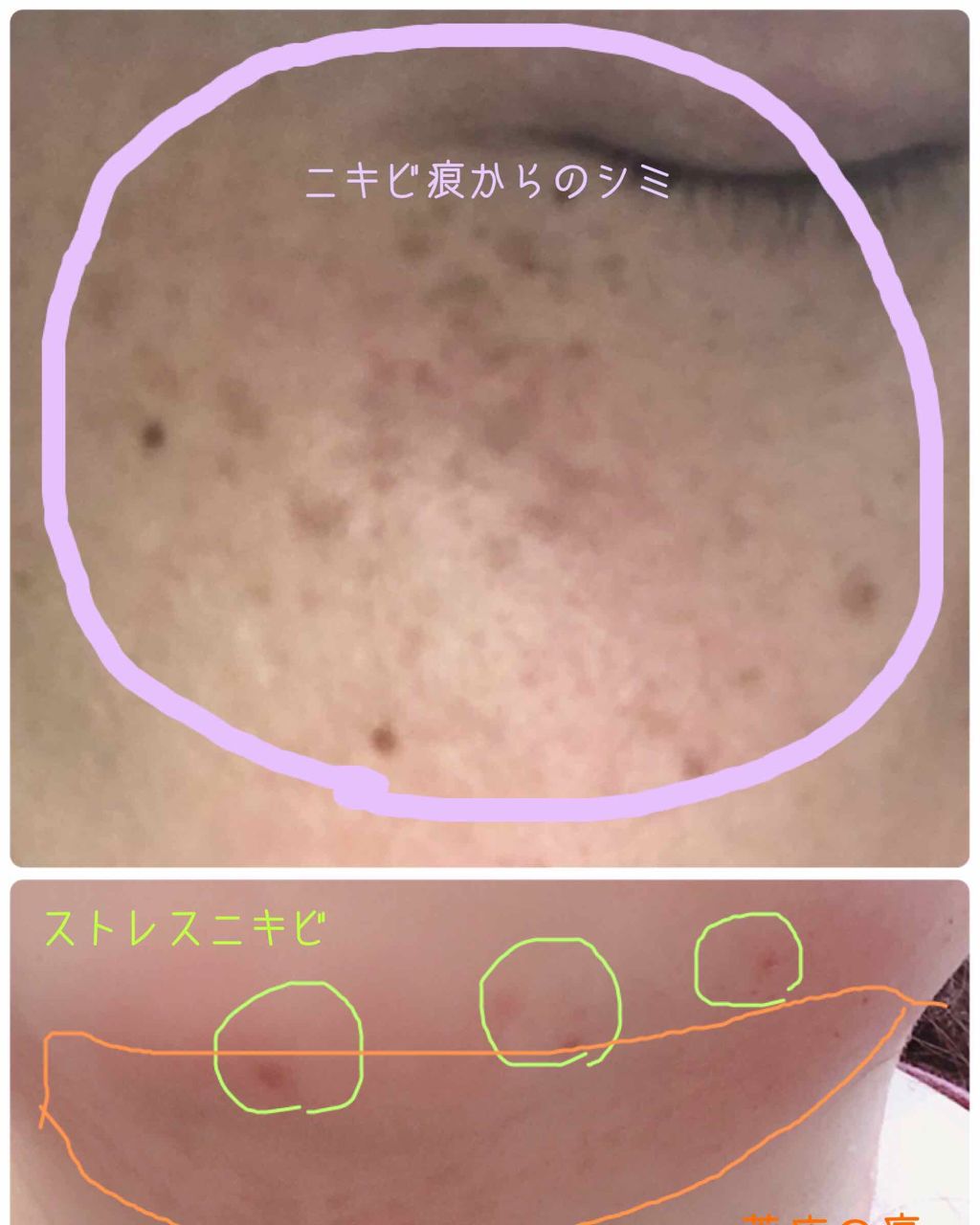 薬用 しみ 集中対策 美容液/メラノCC/美容液を使ったクチコミ(2枚目)