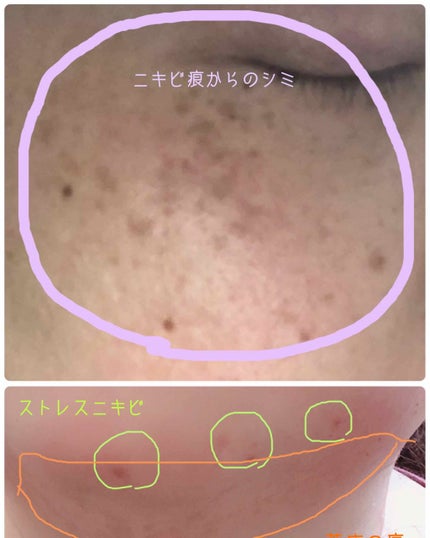 薬用 しみ 集中対策 美容液/メラノCC/美容液を使ったクチコミ(2枚目)