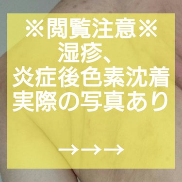 炎症後色素沈着について悩んでいる方はどれくらいいますか？

わたしは汗やストレスで肩甲骨あたりが凄いかゆくなってしまい、皮膚科に通っているにも関わらず掻いてしまいます…
(画像の通りです、ヤバすぎますよ