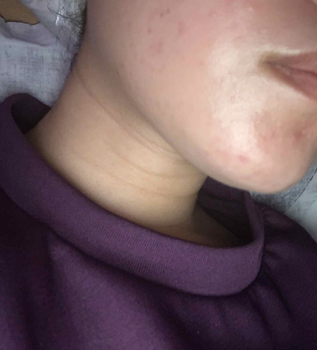 ビーソフテン ローション(医薬品)/持田製薬/その他を使ったクチコミ（2枚目）