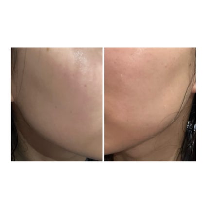 ぽむ on LIPS 「2023.9.13皮膚科に受診 エピデュオとヘパリン処方1枚目..」(5枚目)