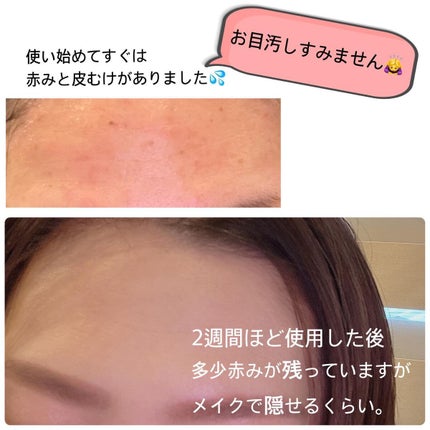 シカレチA エッセンス0.1/VT/美容液を使ったクチコミ(4枚目)