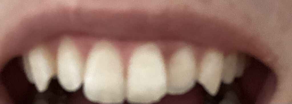 クレスト3Dホワイトニング ホワイトストリップ プロフェッショナル エフェクツ/クレスト/その他オーラルケアを使ったクチコミ（3枚目）