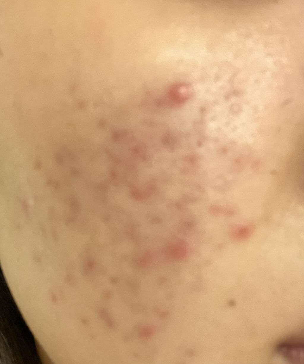 オロナインＨ軟膏 (医薬品)/オロナイン/その他を使ったクチコミ（3枚目）