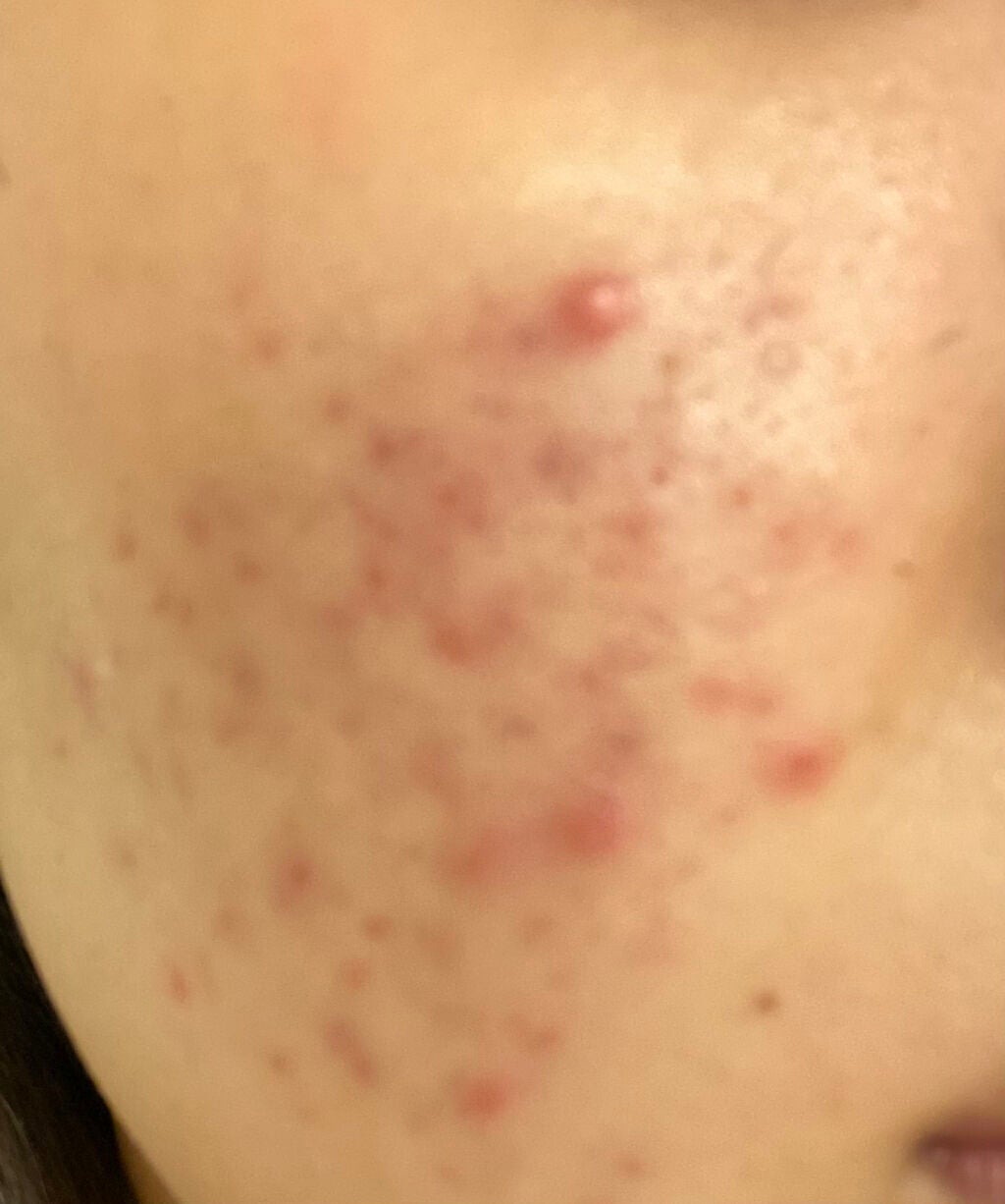 オロナインH軟膏 (医薬品)/オロナイン/その他を使ったクチコミ(3枚目)