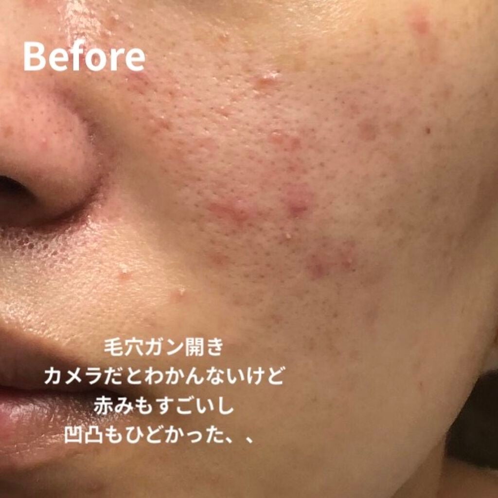 リアルカロテンブレミッシュクリアセラム/APRILSKIN/美容液を使ったクチコミ(2枚目)