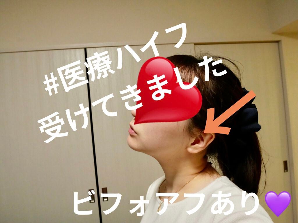 akðŒ on LIPS ã#ãã€ãã#HIFU#ã¬ããïŒïŒ#ãã€ãã¬ã#äºéé¡ãæéãé..ãïŒ1æç®ïŒ