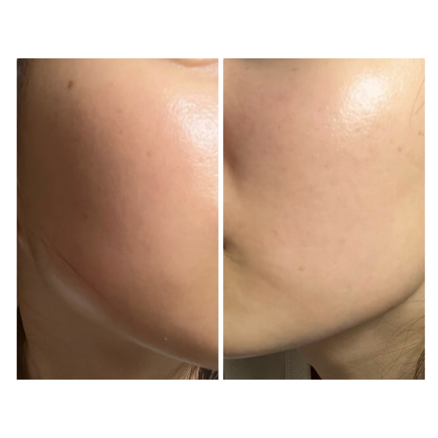 ぽむ on LIPS 「2023.9.13皮膚科に受診 エピデュオとヘパリン処方1枚目..」(1枚目)