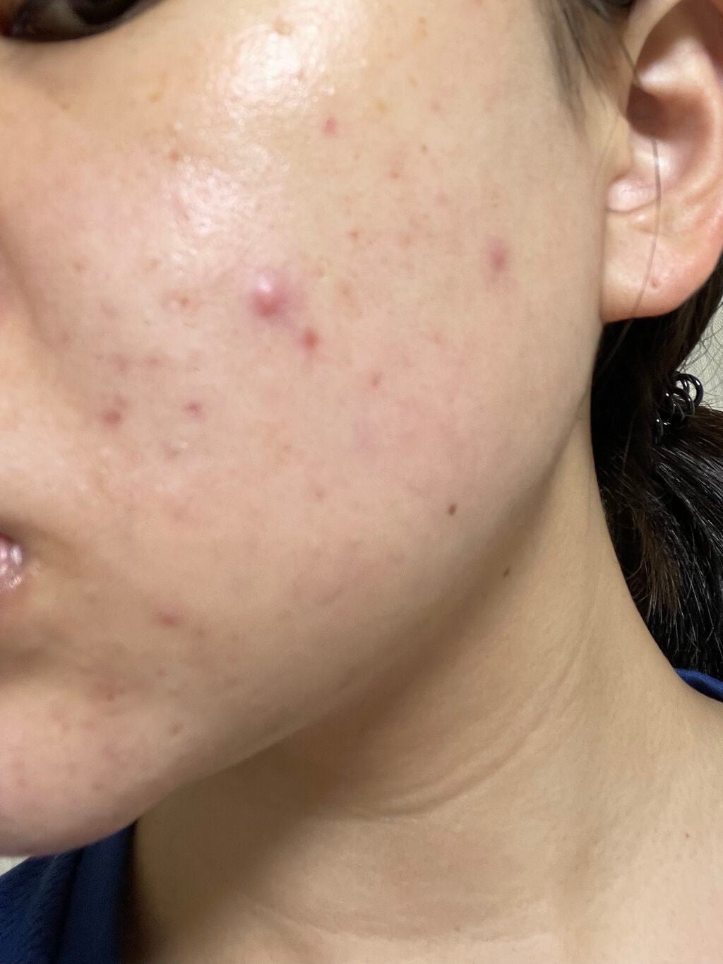 まままこ on LIPS 「ニキビゼロ肌を目指して〜1日目〜⚠️2枚目から肌画像ありスキン..」(3枚目)