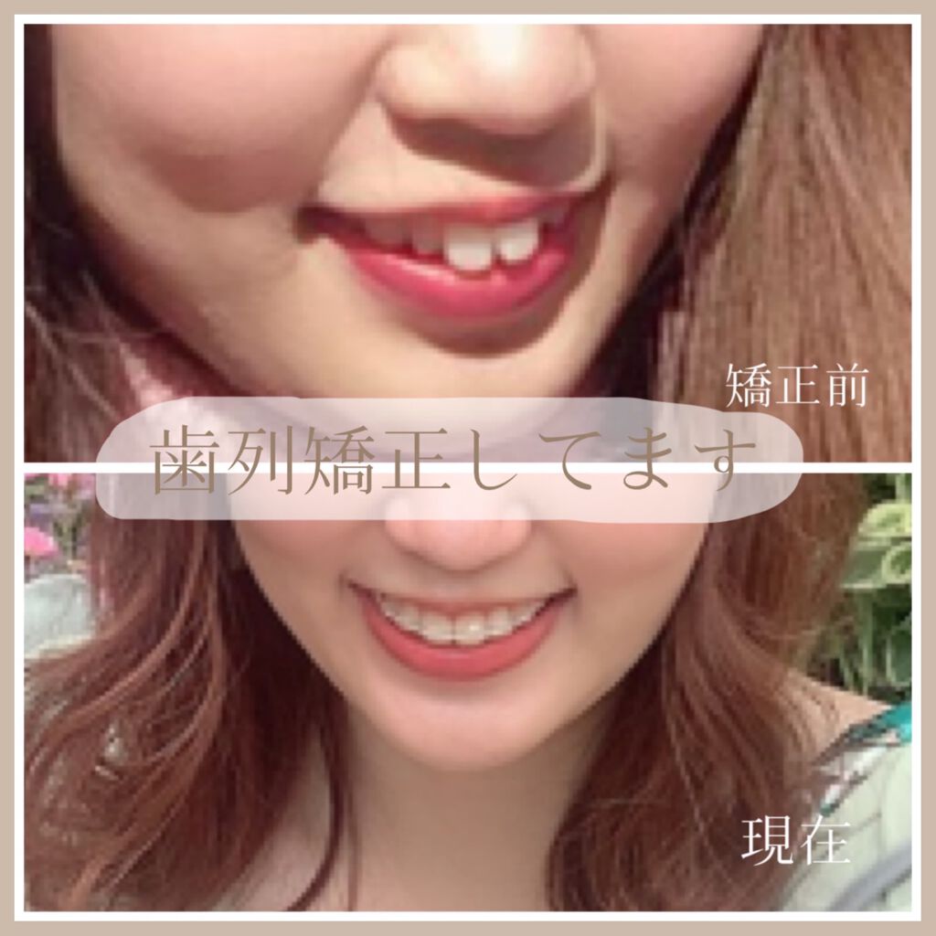 Sちゃん@歯列矯正 フォロバ on LIPS 「𓇼※2枚目 口内写真あり名前にもあるように、わたしは歯列矯正を..」(1枚目)