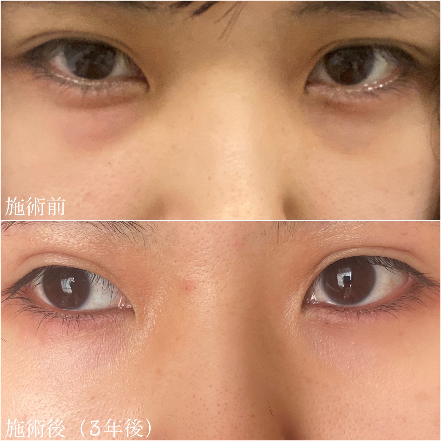 ERIKA on LIPS 「目の下のふくらみ取りをしました!目の下のふくらみとは、クマ治療..」(4枚目)