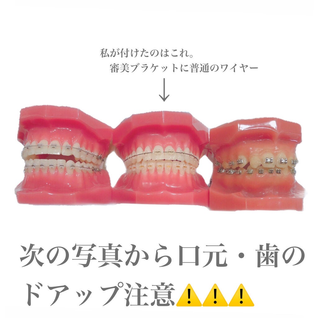 チャンユカ on LIPS 「歯列矯正について長々と記録兼ねて。。。興味がある方、参考になれ..」（2枚目）