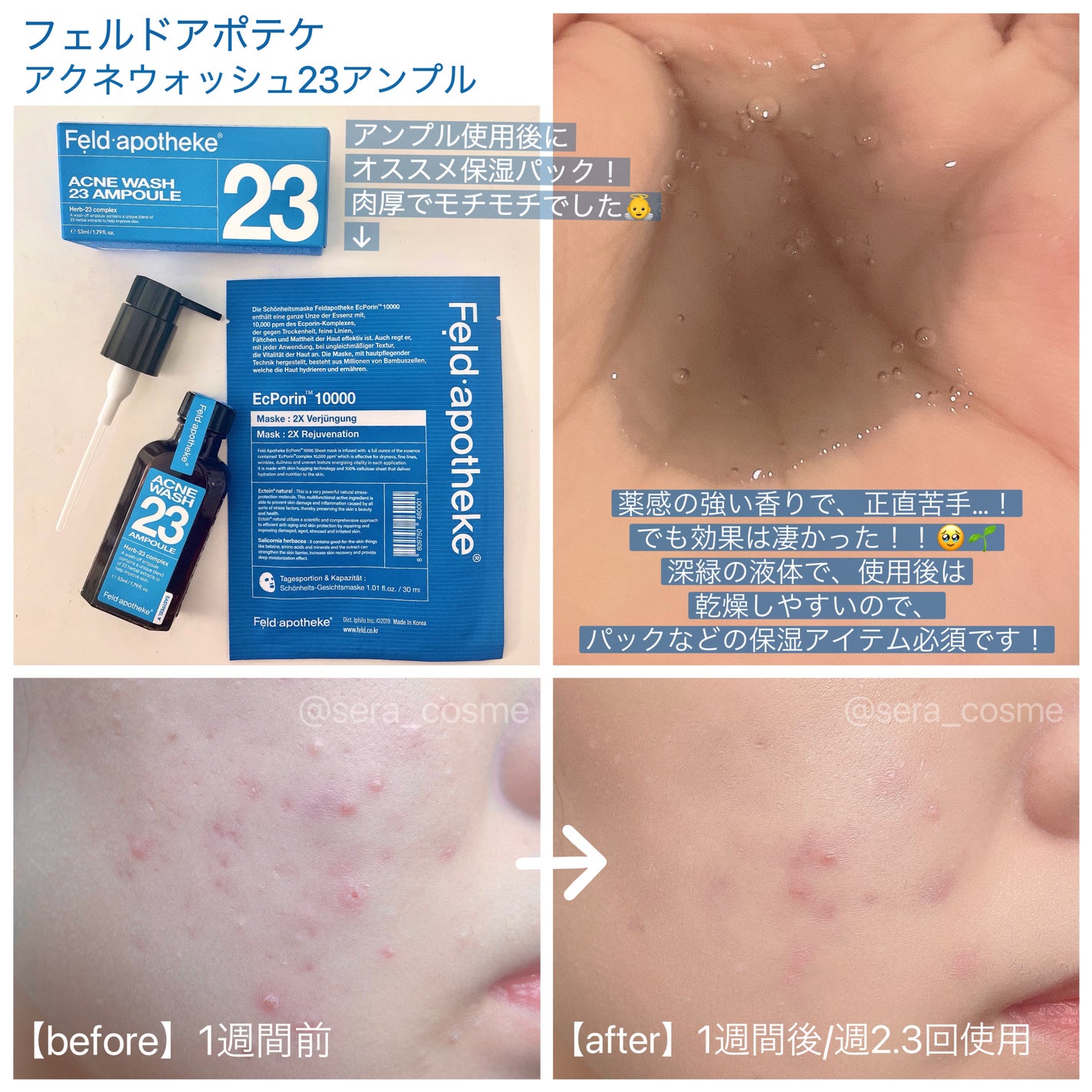 アクネウォッシュ23アンプル/Feld Apotheke/美容液を使ったクチコミ(1枚目)