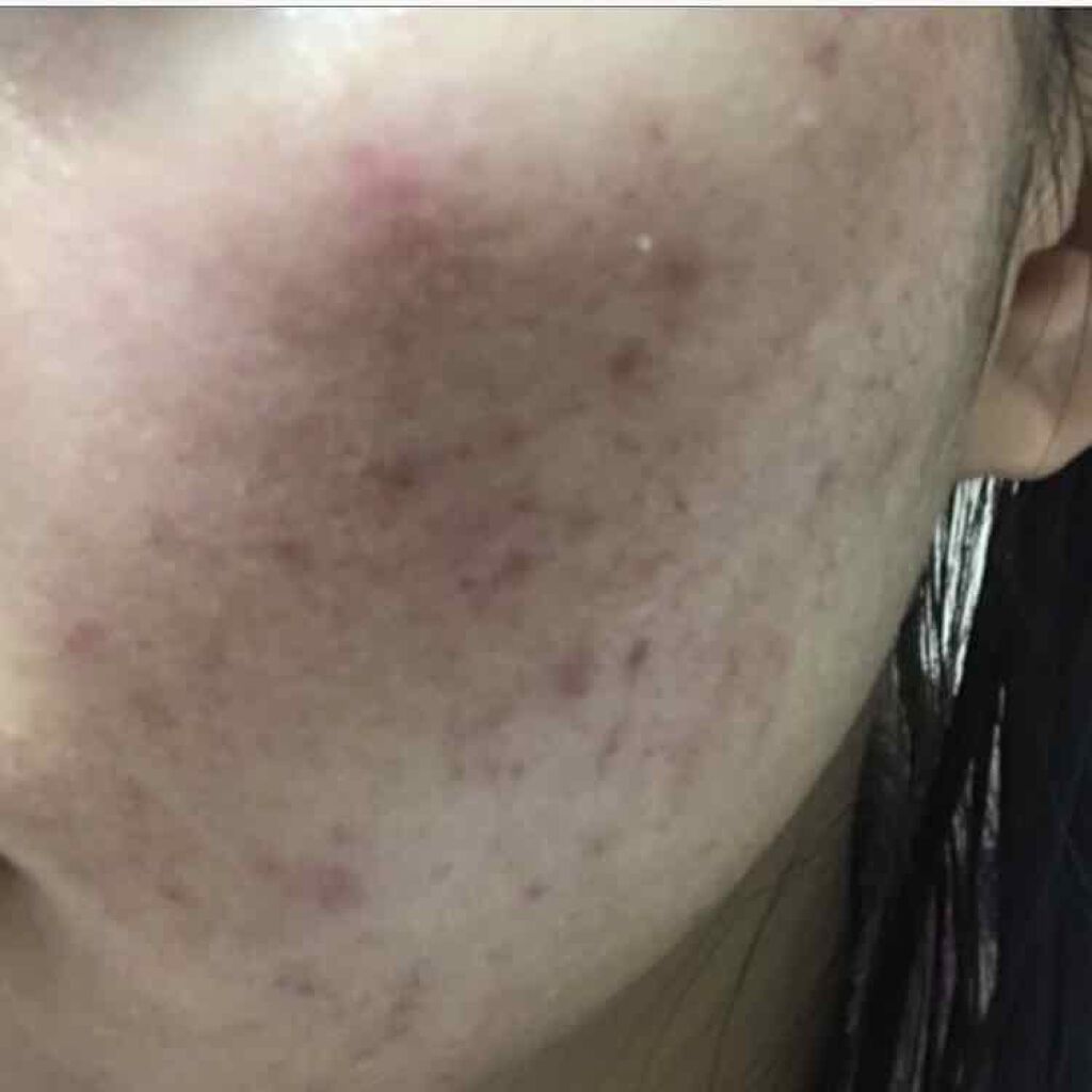 いちご on LIPS 「ディフェリンゲル1週間使用した比較です。よくなってる気もするけ..」(2枚目)