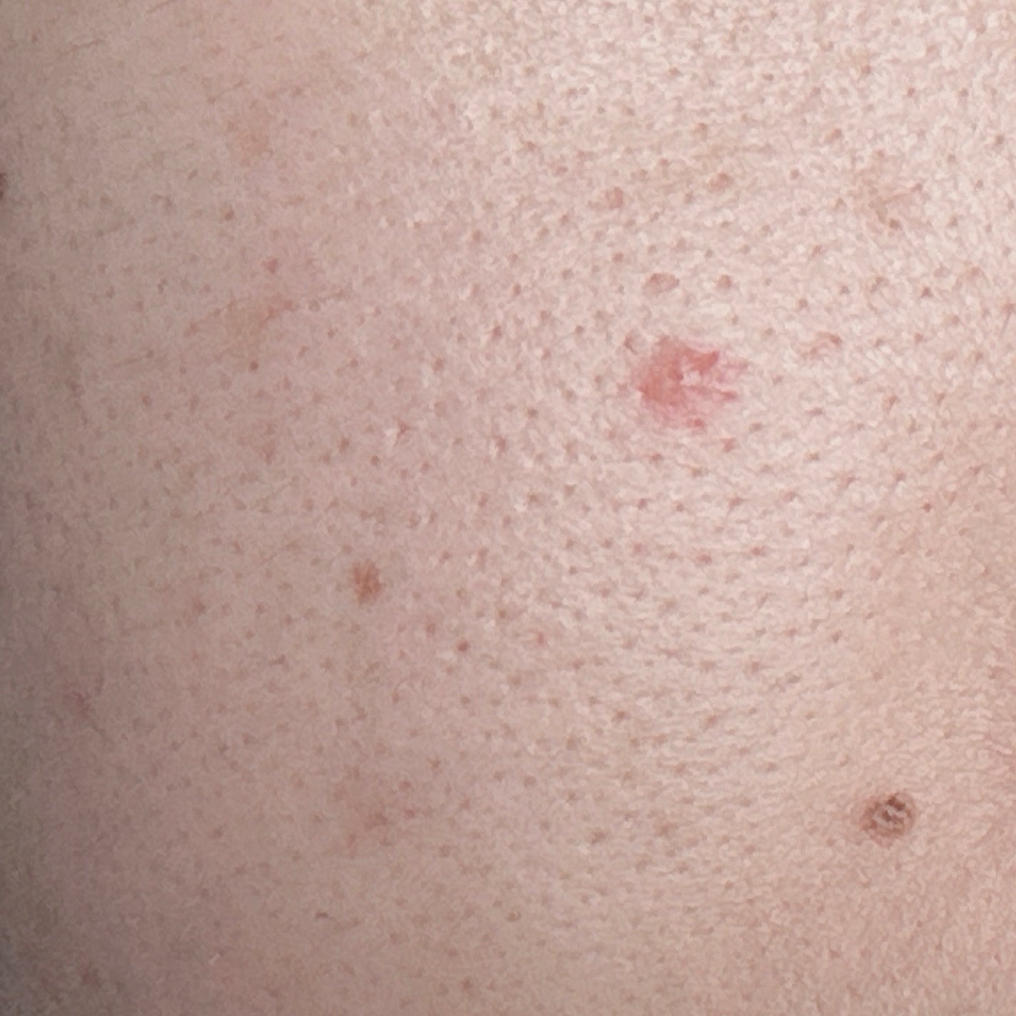 薬用コンシーラー アクネプロテクター/ONLY MINERALS/パウダーコンシーラーを使ったクチコミ(3枚目)