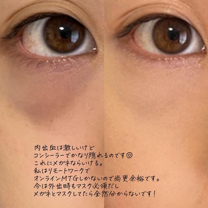 m♡ on LIPS 「念願の、目の下の脱脂をしてきました!!!!1ヶ月経ったらレポし..」(5枚目)