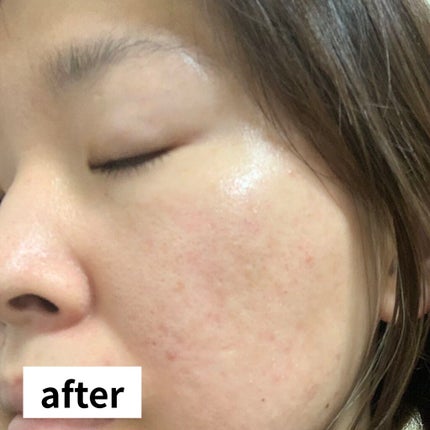 プロヒアルショット モイスチャーピーリングパッド/Dermatory/トナーパッドを使ったクチコミ(8枚目)