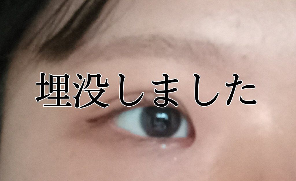 二重整形/その他を使ったクチコミ（1枚目）