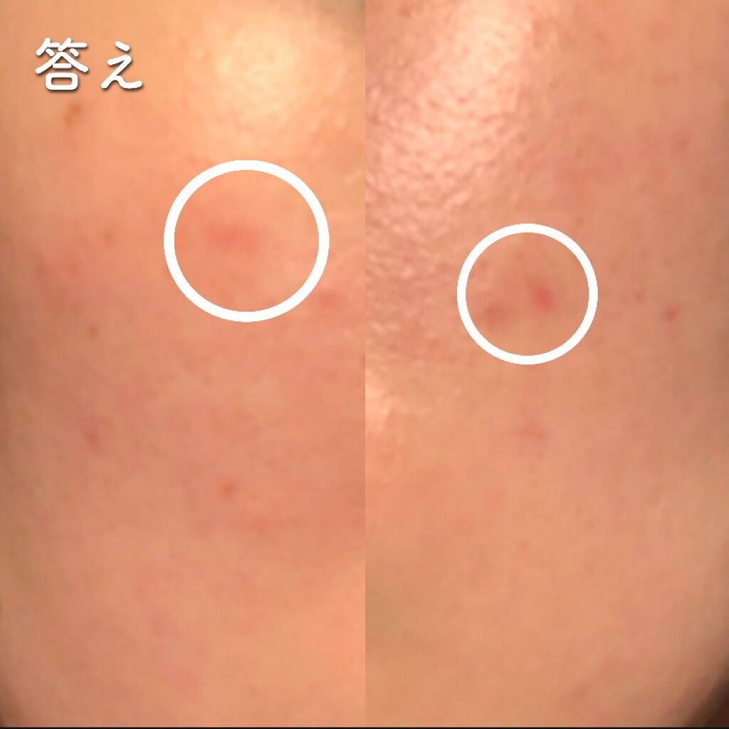 A-zero Shot スキンドレッシングパッチ/MEDIHEAL/シートマスク・パックを使ったクチコミ(2枚目)