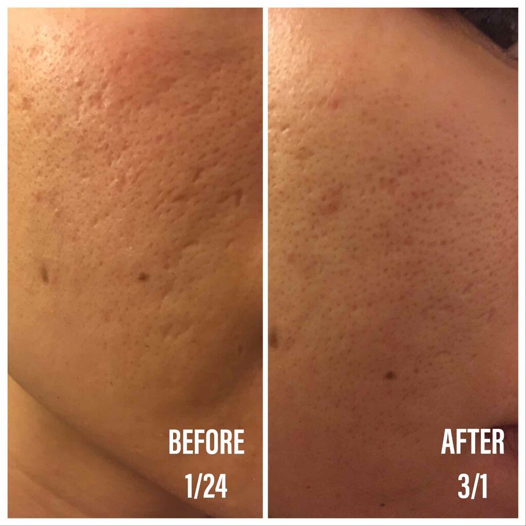 DS ライン コンセントレート 12.5 C/Kiehl's/美容液を使ったクチコミ（3枚目）