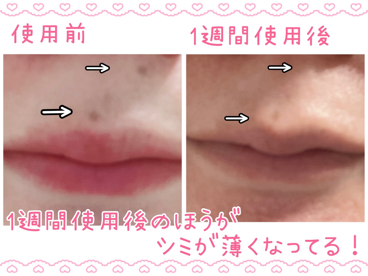 メラキャプチャーアンプルRX/センテリアン24/美容液を使ったクチコミ(3枚目)