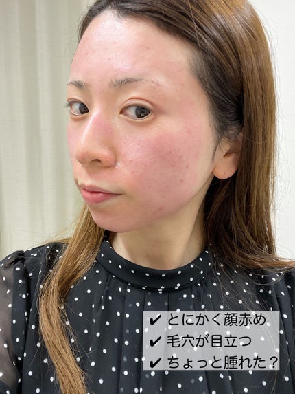 あゆみんっ。 on LIPS 「最近何かと話題な美容医療施術【ダーマペン4】当日終わってまで編..」(5枚目)