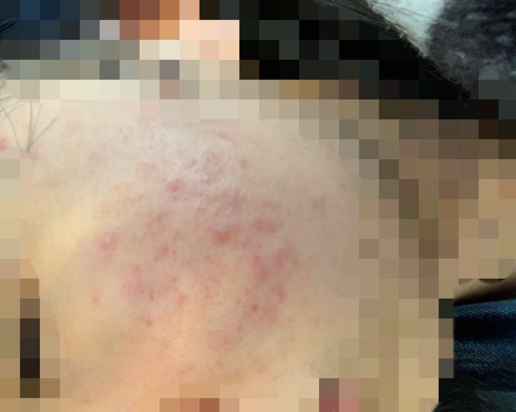 薬用 しみ 集中対策 美容液/メラノCC/美容液を使ったクチコミ（2枚目）