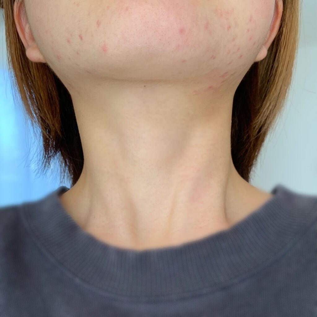 ゆる on LIPS 「※2枚目から肌の写真となります(自然光、外カメラ撮影)最初から..」(2枚目)